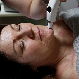 Microdermabrasion Treatment