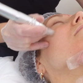 Microneedling Eden Beauty Group