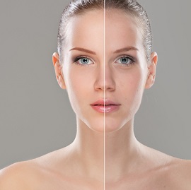 Rosacea Treatment Eden Beauty Group