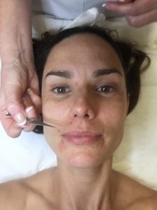 Alison Canavan Facial Extraction Eden Beauty Group