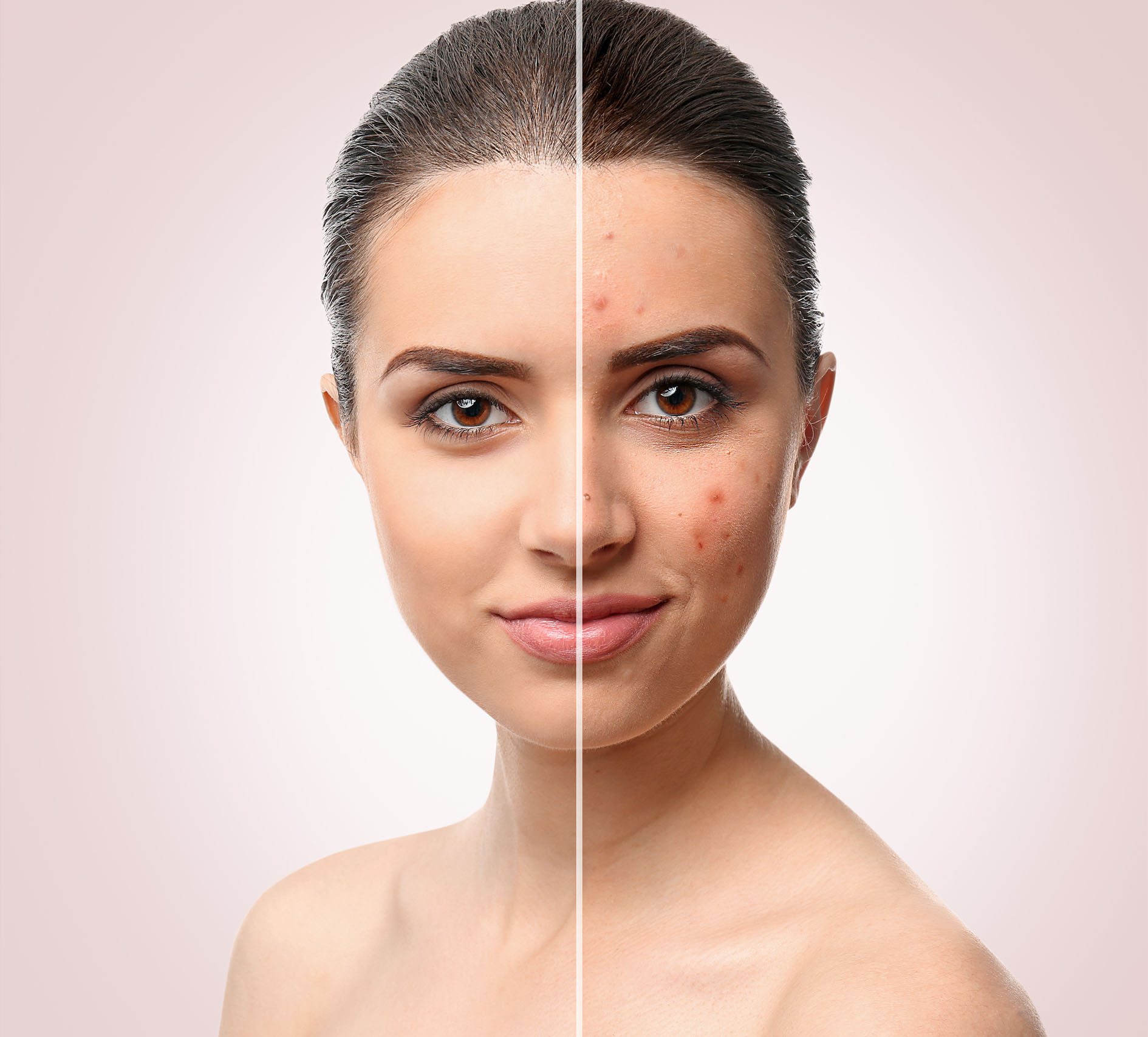Young Model Woman with Skin Problem. Female Face Divided into tw